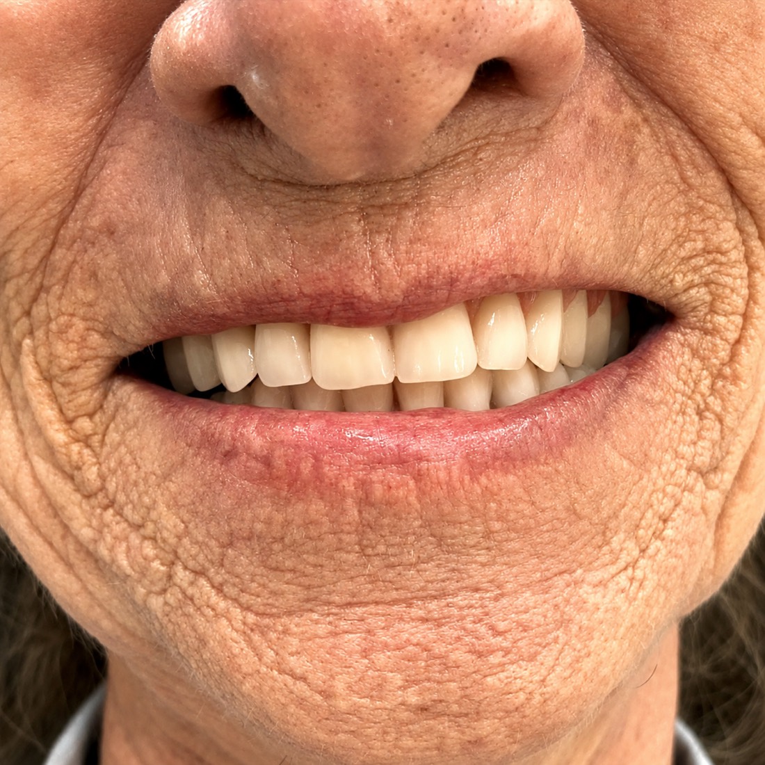 Reabilitação dental com aparência natural